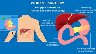 My Life After the Whipple Surgery