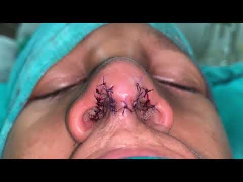 Bilateral Cleft Rhinoplasty