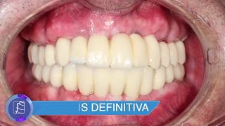 Rehabilitación completa superior e inferior con implantes y carga inmediata  Caso completo