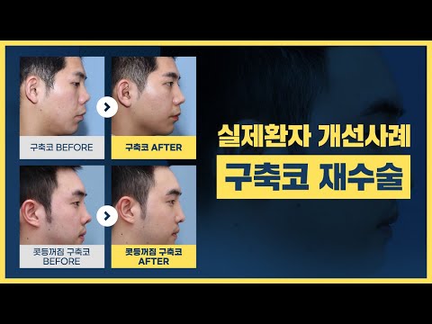 남자코성형부작용 안장코&구축코 현상 실제환자 개선사례
