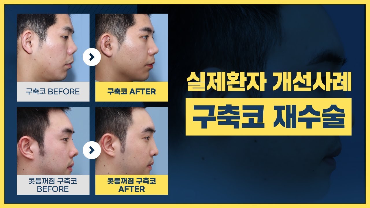 남자코성형부작용 안장코&구축코 현상 실제환자 개선사례
