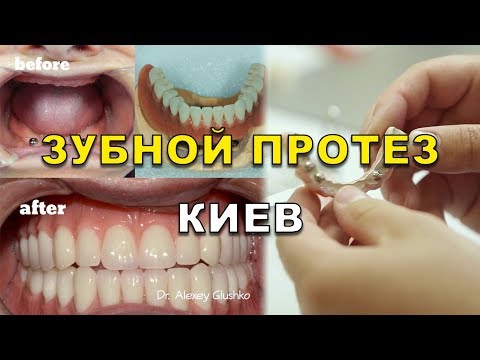 Знімні Протези Реферат