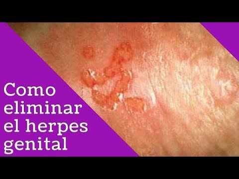 Tratamiento Herpes Genital Masculino – Tratamiento De Herpes – Cura Para El Herpes