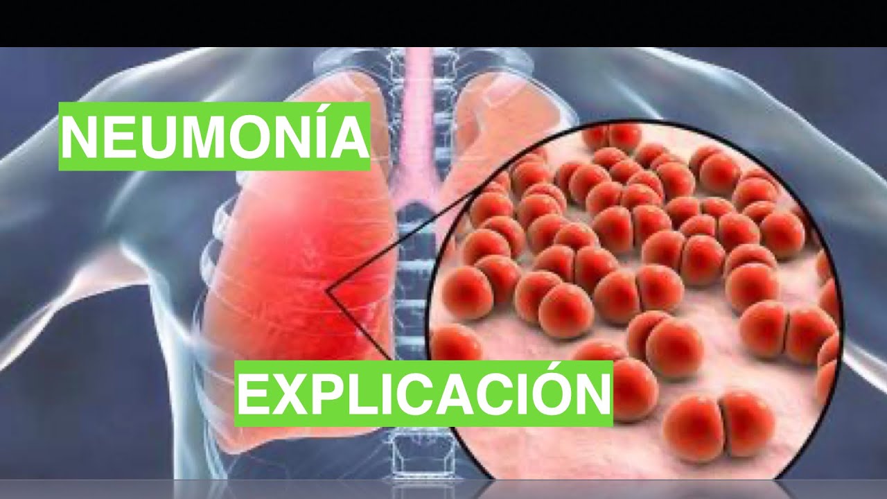 ¿Cómo se produce la Neumonía Fisiopatología de la Neumonía.