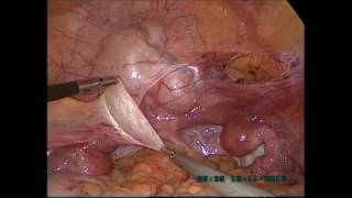 LAPAROSCOPIC VAGINOPLASTY: DOVYDOV&#39;S TECHNIQUE