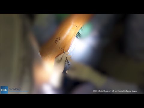 Image - Osteotomy and Remote Controlled Intramedullary Nail Insertion: Live Surgery