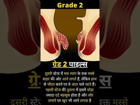 About Grade 2 Piles #youtube #shorts #youtubeshorts #piles