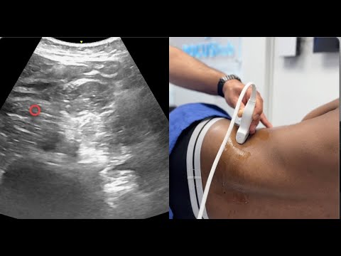 New Scanning Tutorial for Quadratus Lumborum Blocks