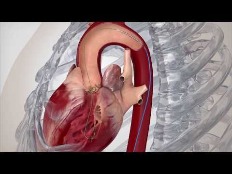 TAVR: A New Treatment for Aortic Stenosis