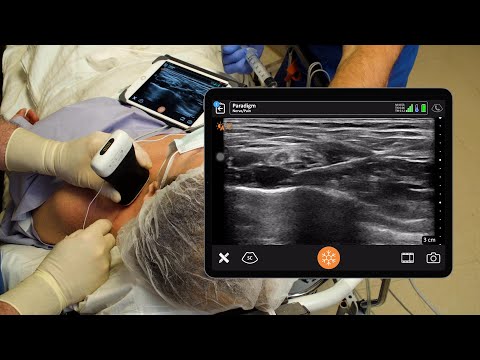 Supraclavicular Brachial Plexus Block
