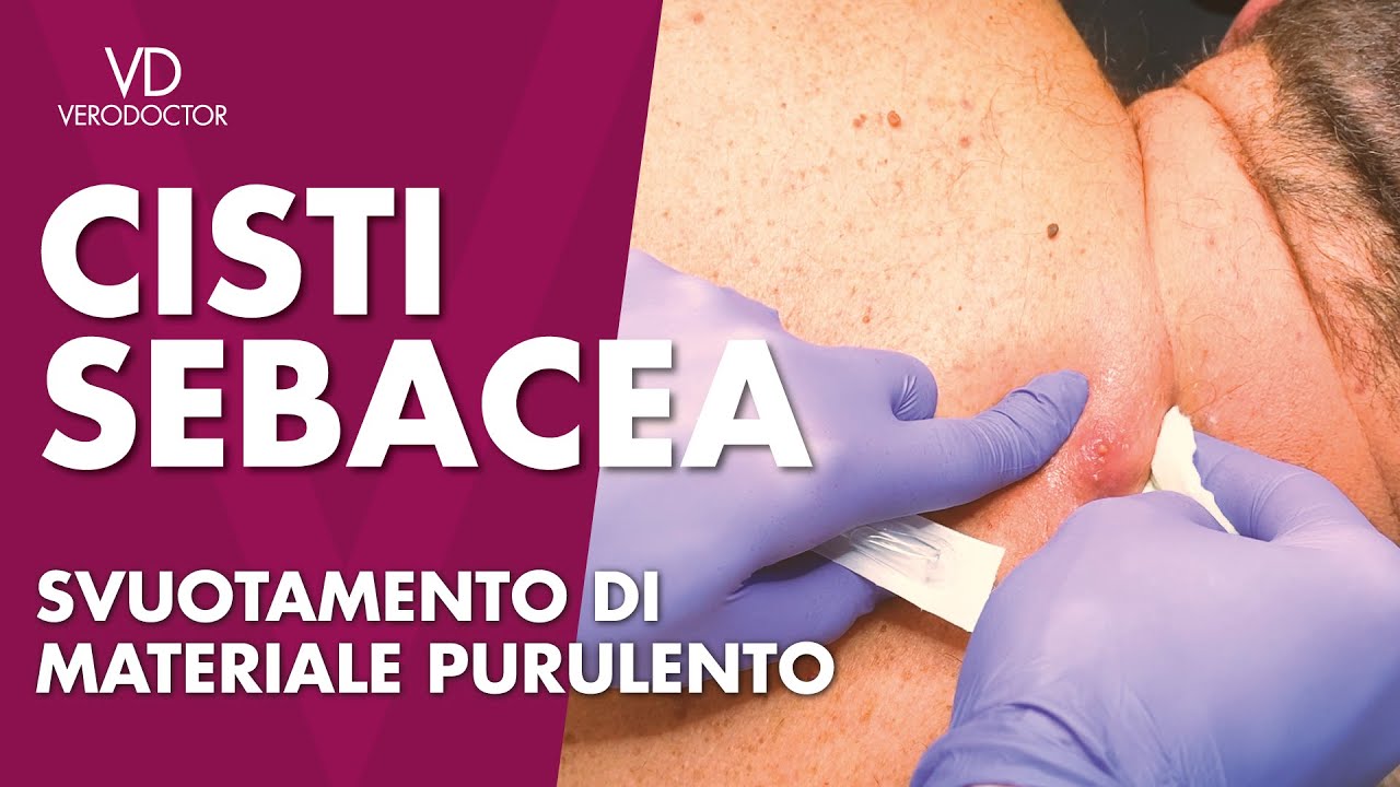 Medicazione Cisti Purulenta con l'estrazione di Pus - VERODOCTOR