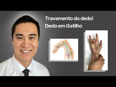 The Most Comprehensive Video on Trigger Finger