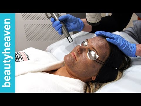 download lagu mp3 mp4 Hollywood Laser Peel Sydney, download lagu Hollywood Laser Peel Sydney gratis, unduh video klip Hollywood Laser Peel Sydney