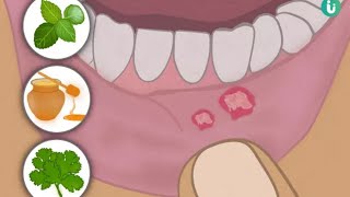 Como CURAR afta na lngua [FCIL e RPIDO]