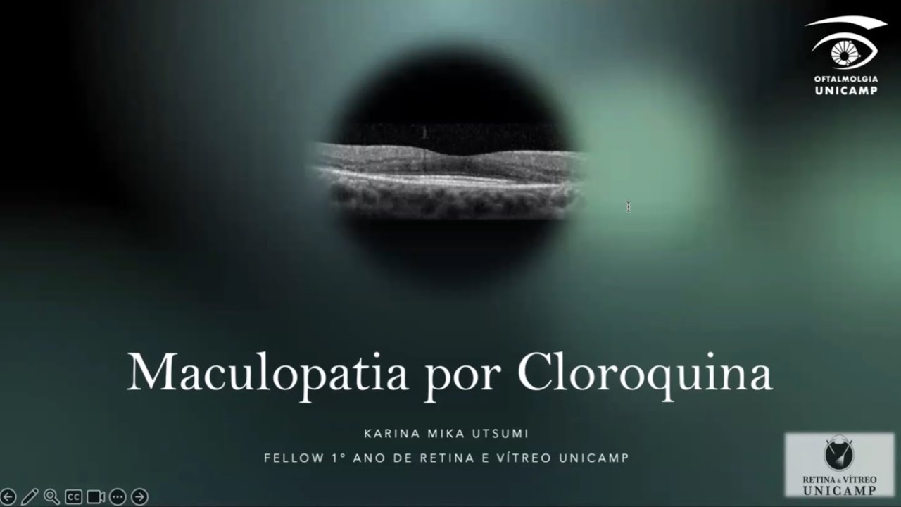 Retina e Vítreo (04/07/2024) - Maculopatia por Cloroquina