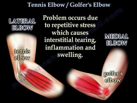 Tennis Elbow / Golfer's Elbow