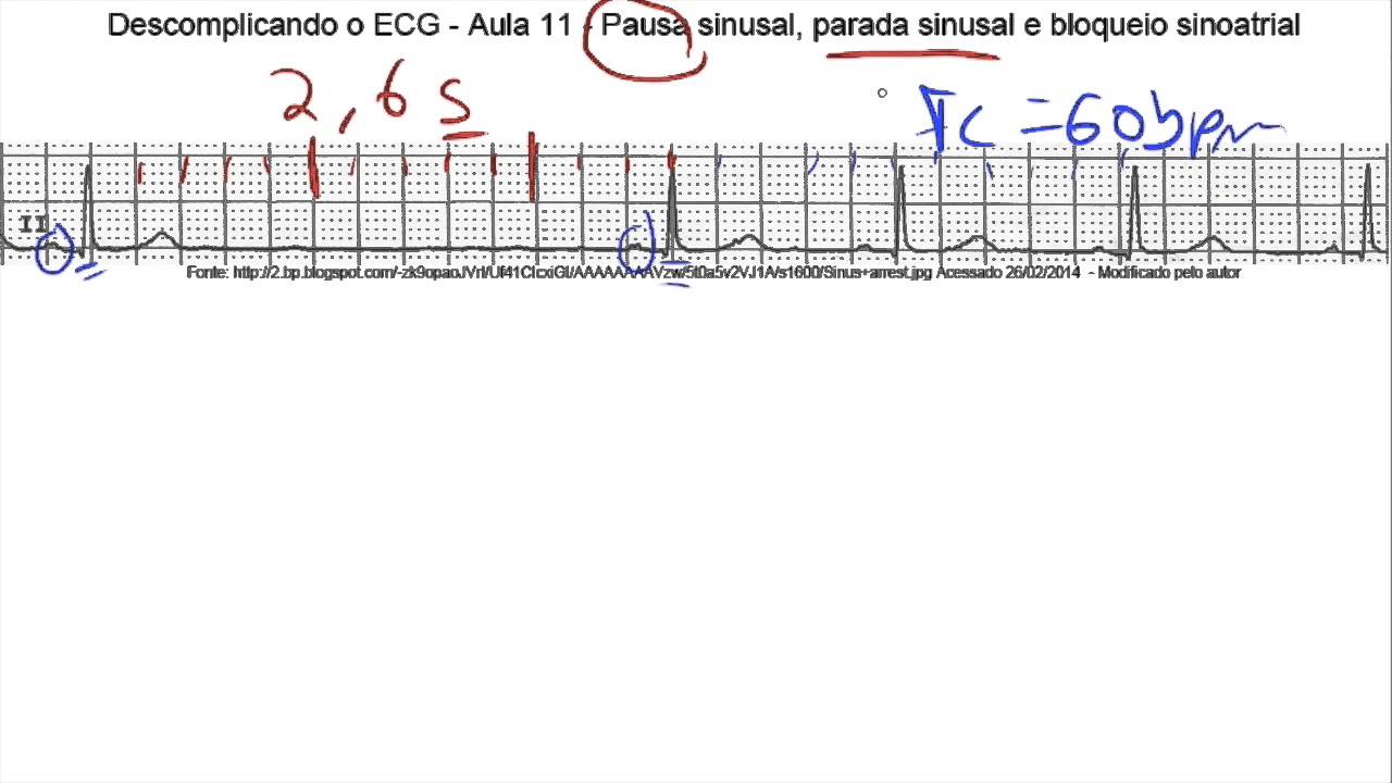Descomplicando o ECG - Aula 11- Parte 1 - Pausa e parada sinusal e marcapasso atrial migratório