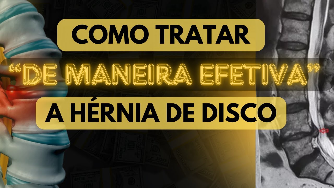 Como tratar "DE MANEIRA EFETIVA" a HÉRNIA DE DISCO.