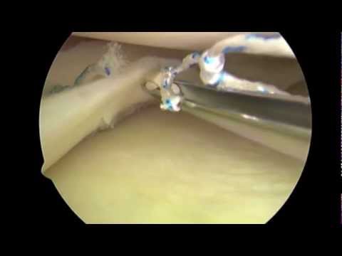 Arthroscopic Knee Surgery Meniscectomy vs Meniscus Repair