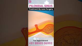 Pilonidal Sinus ka Permanent Ilaaj – Dard Se Mile Chutkaara #pilonidal #sinus #permanent #illaj