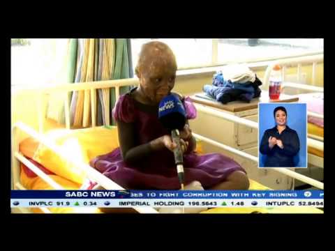 May is Burn Victim's Month