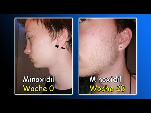Minoxidil Woche 28 (Monat 7) | Interaktives Video?☝🏻