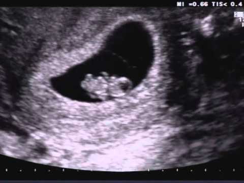 Ecografia 8 settimana di gravidanza commentata
