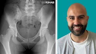 Hip Dysplasia video