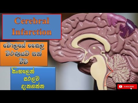 Cerebral infarction/මොලයේ සෛල මියයාම/how it happens/causes/sinhala/treatment/how to prevent