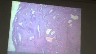 42) Dr.Samira 28/3/2016 [ Carcinoma of the cervix till tumors of the uterine body ]