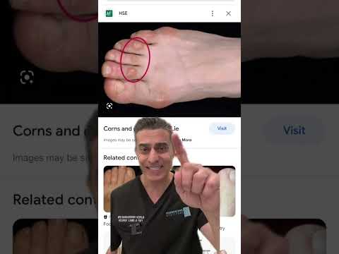 Corns & Callus On Feet? Foot Doctor Explains