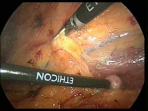 Right Laparoscopic Radical Nephrectomy - Part 2