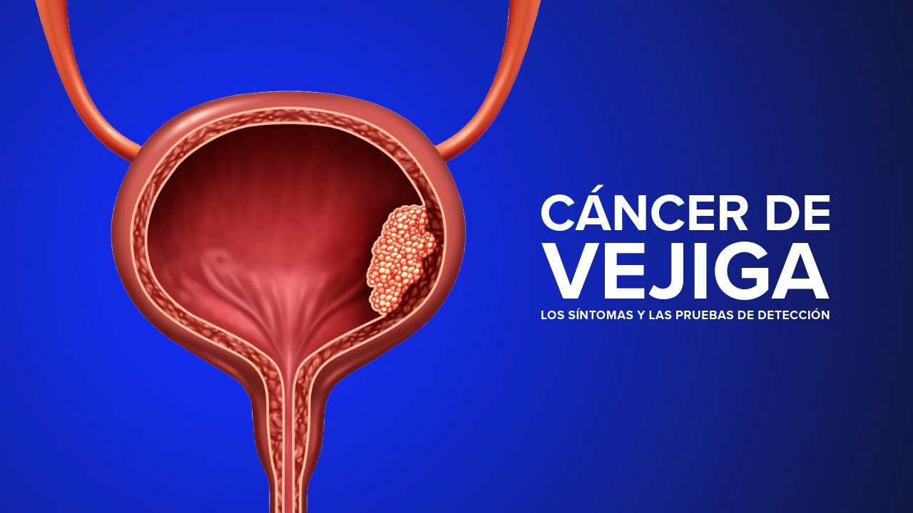 Thumbnail preview of Cáncer de Vejiga - Los síntomas y las pruebas de detección | UC Davis Health