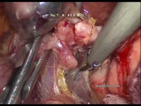 Giardiaza canalului biliar