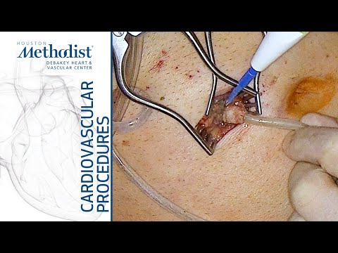 Peritoneal Dialysis Catheter Removal 