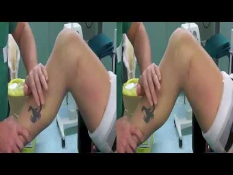 Artroplastica dellarticolazione della spalla destra Fluido nel ginocchio di video chirurgia congiunta