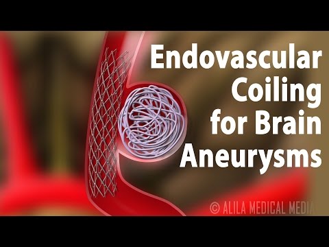 Endovascular Coiling for Brain Aneurysm