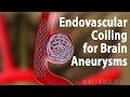 Endovascular Coiling For Brain Aneurysm Animation
