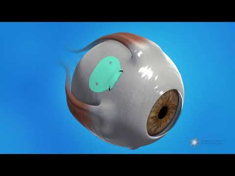 What happens during glaucoma drainage implant surgery?