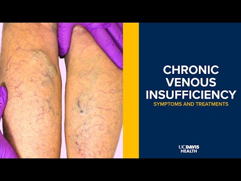 Vein Disease: The Hidden Epidemic | Community Health