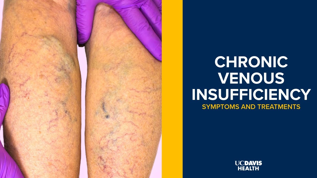 Thumbnail preview of What Is Chronic Venous Insufficiency? Symptoms, Causes & Treatments Explained | UC Davis Health