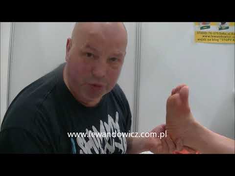 Film Operacja koślawe zniekształcenie Usuwanie kości w stopie