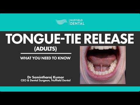 Tongue-Tie Release for Adults: What You Need To Know (FULL)