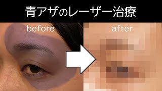 【太田母斑】青アザのレーザー治療の実際