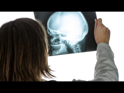 Le traumatisme craniocérébral, une blessure sournoise