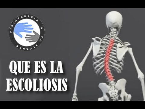 Que es la escoliosis de columna