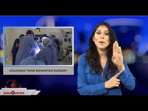 Conjoined twins separation surgery (ASL - 11.10.18)