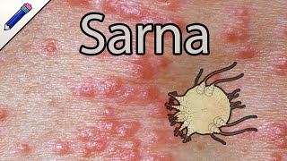 Sarna Humana Escabiosis ¿Cómo saber si tengo Sarna Síntomas Tratamiento Cura