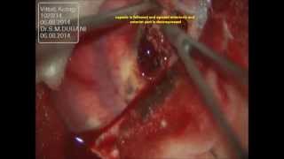 preview picture of video 'METASTSIS BRAIN-left frontal motor area-navigation guided microsurgery-dr suresh/HUBLI/INDIA'