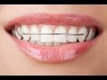 Как ставят пластины на зубы? Больно или нет? 